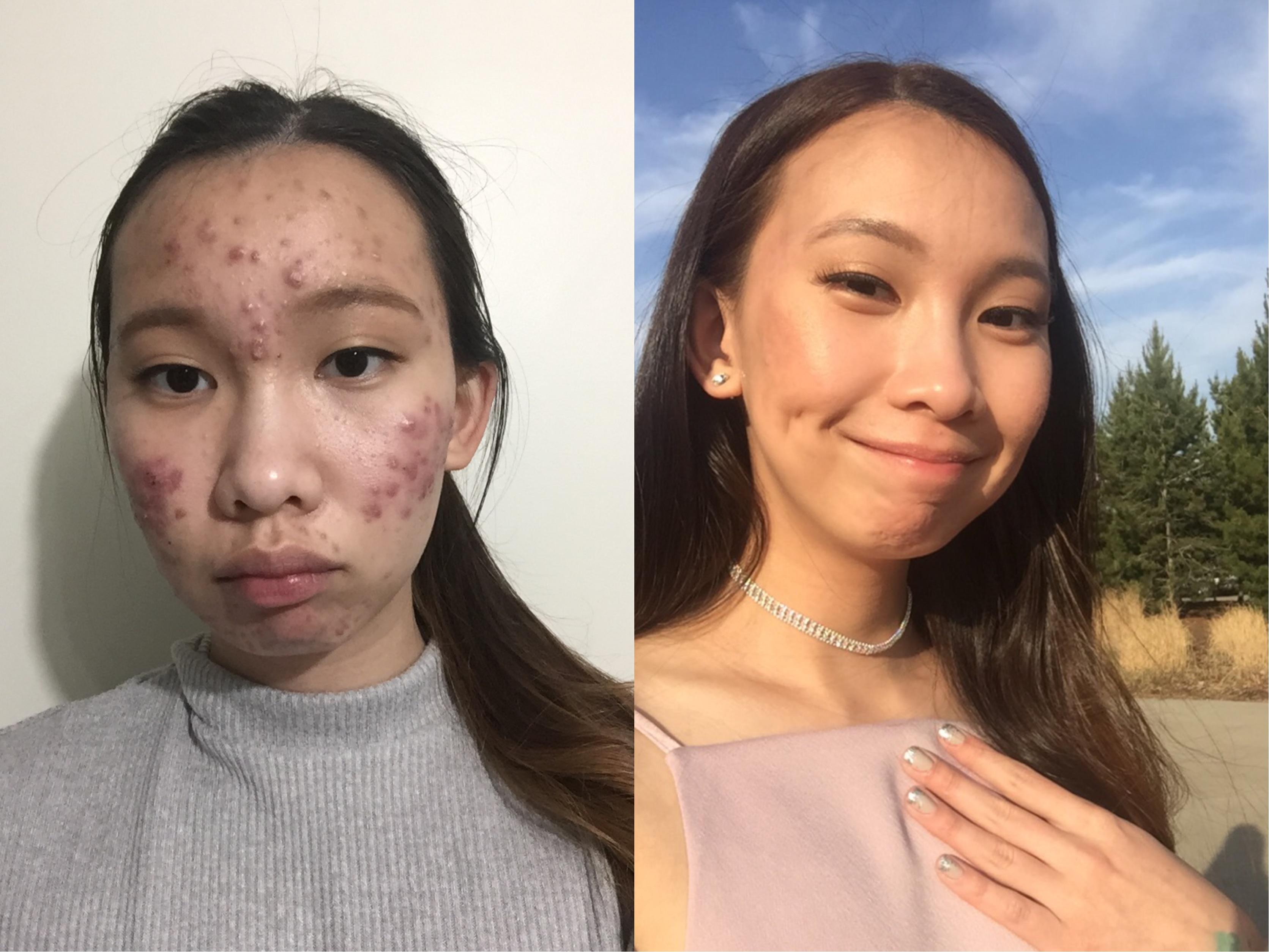 Price of roaccutane in ireland